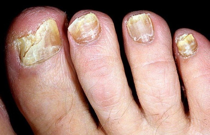 Деформированные ногти при грибке
