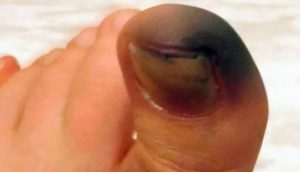 Потемнел большой палец на ноге причины лечение thumbnail