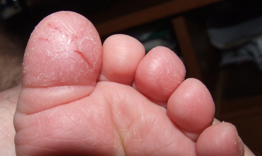 Лечение трещин между пальцев ног