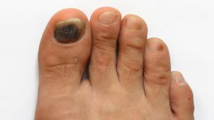 Лечение почерневших пальцев ног thumbnail