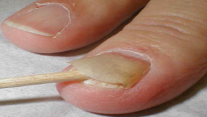 Снятие ногтевой пластины