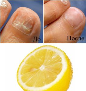 До и после лечения ногтя лимоном