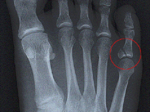 Перелом пальца на рентгеновском снимке