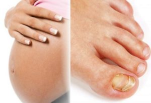 Беременность и грибок ногтя