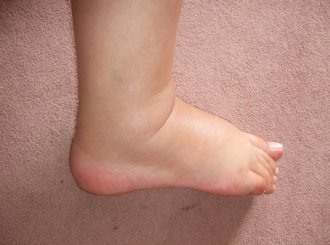 Чем мазать ногу после перелома лодыжки после снятия гипса
