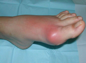 Шишка на ноге возле щиколотки лечение