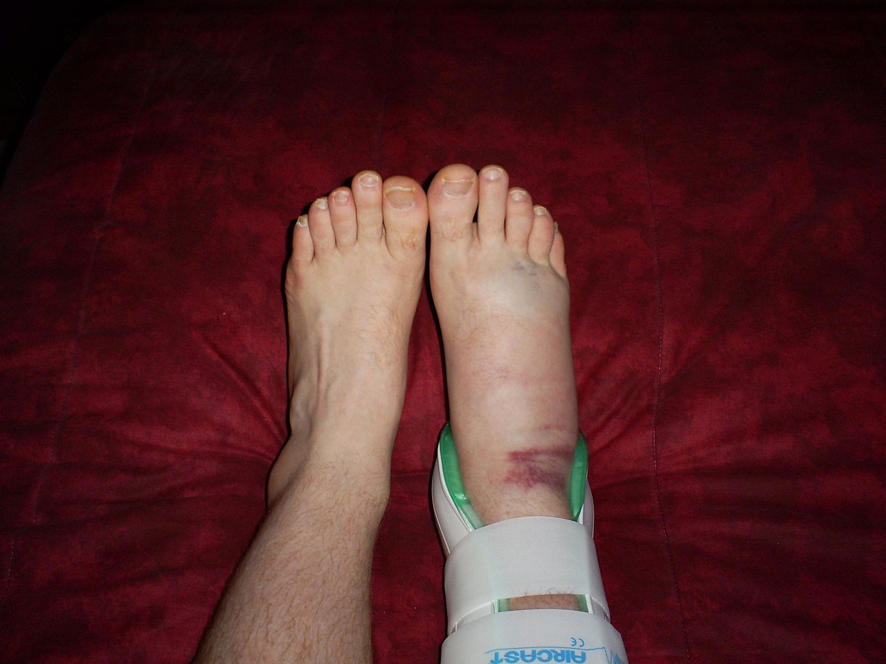 Как выглядит перелом пальца на ноге фото