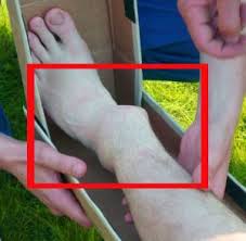 Острая боль в лодыжке при наступлении на ногу без травмы с внешней и внутренней сторон
