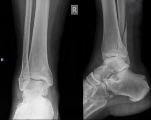 Перелом лодыжки со смещением на рентгеновском снимке