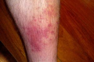 Сыпь и зуд на ногах у взрослого лечение