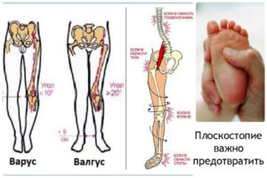 Вальгусные голени код по мкб 10 у детей