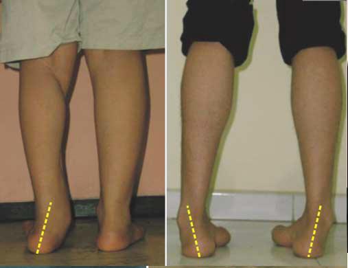 Вальгусное искривление ног у ребенка: причины и лечение