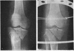 Перелом мыщелка большеберцовой кости реабилитация сроки