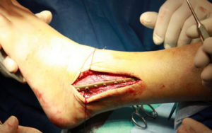 Штифт в ноге при переломе голени