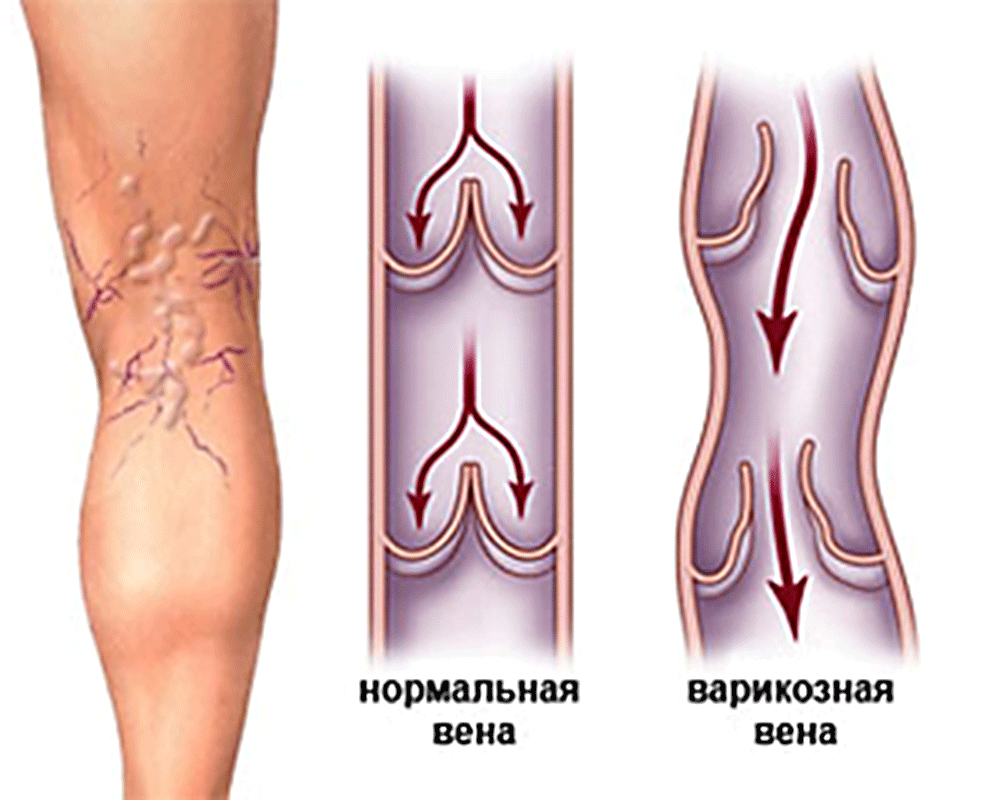 Вены лечение