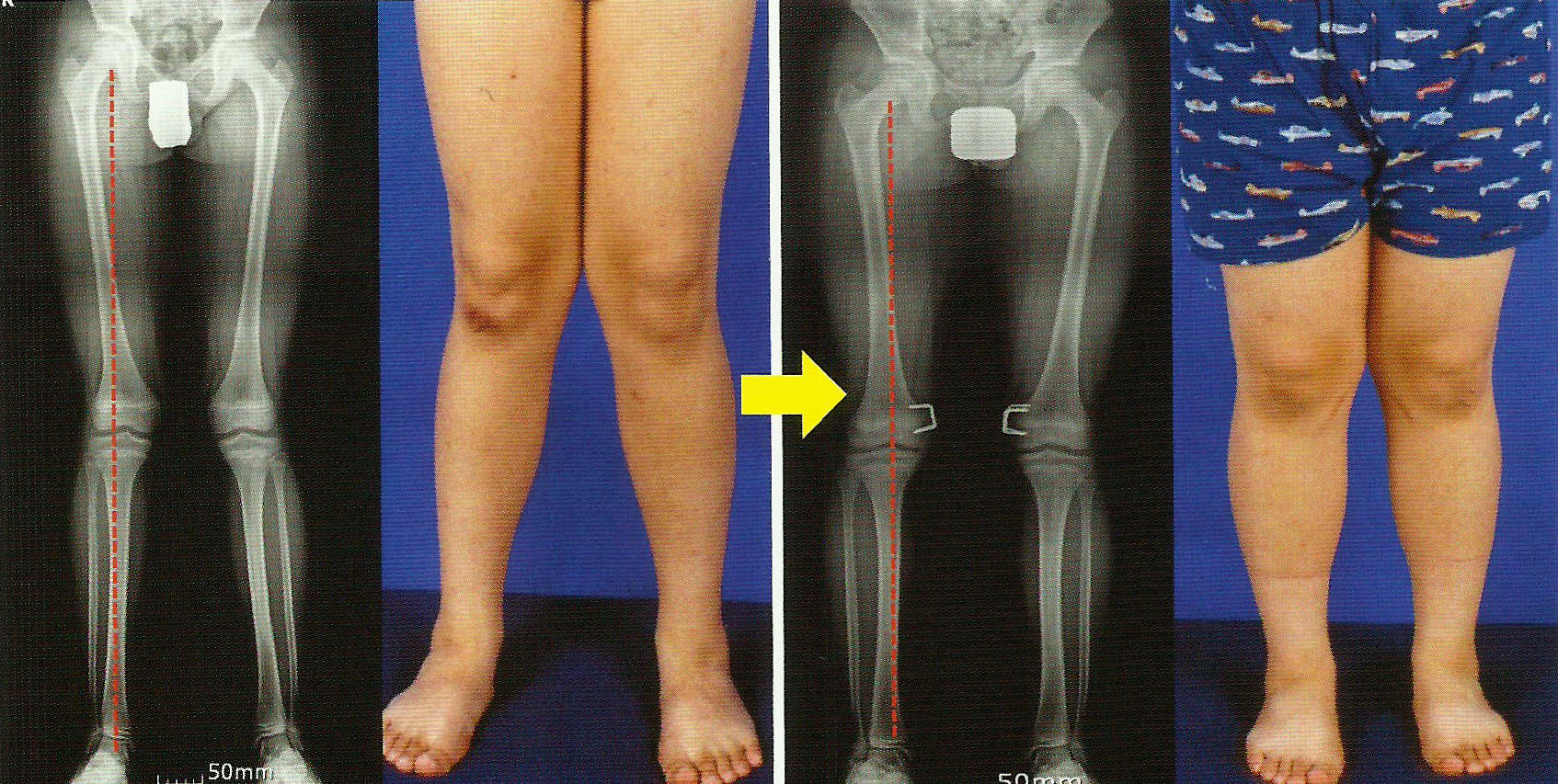 Болезнь суставов у взрослых. Вальгусная и варусная деформация. Вальгус коленных суставов. Варусная дисплазия коленных суставов. Варусная и вальгусная деформация коленного сустава.