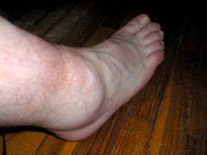 Болит голень ноги в покое