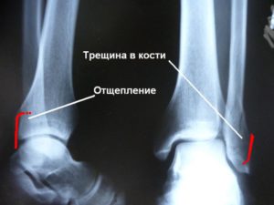 Трещина на голени ноги лечение