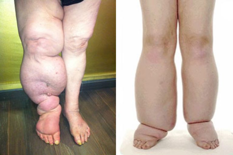Как лечить лимфостаз и трофические нарушения нижних конечностей голени и стопы