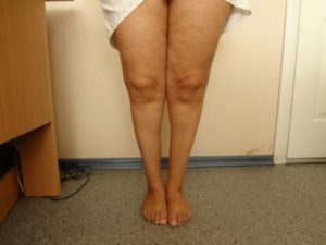 Лечение атрофии мышц ног бедра и голени