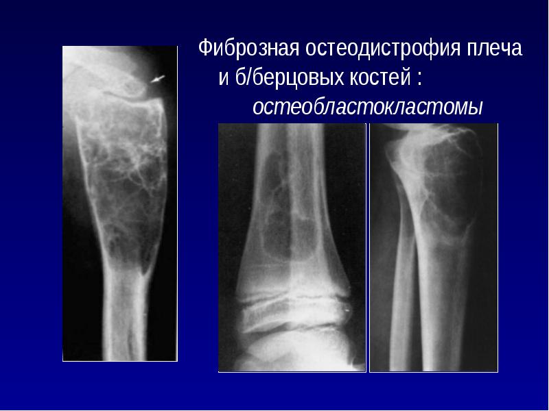 Фиброзная дисплазия большеберцовой кости у детей фото