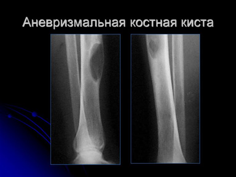 Для рентгенологической картины фолликулярной кисты характерна деструкция костной ткани