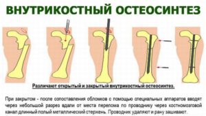 Переломы костей голени чрескостный остеосинтез