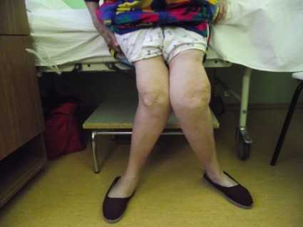 Артроз коленного сустава 3-4 степени: лечение без операции, фото ...