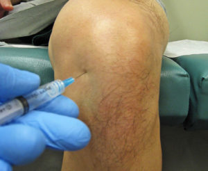 Артрит коленного сустава симптомы и лечение какой врач лечит thumbnail
