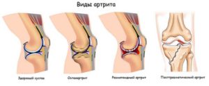 При обострении артроза и артрита коленного thumbnail