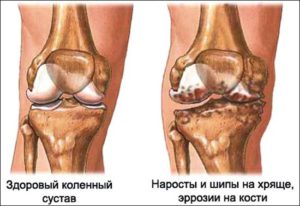 Артрит артроз коленного сустава помогите thumbnail