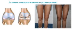 2-ая степень гонартроза коленного сустава