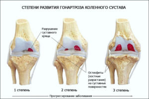 3 степени гонартроза коленного сустава