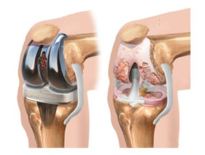 Эндопротезирование колена