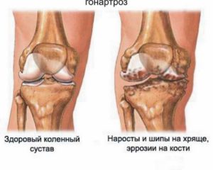 гонартроз коленного сустава