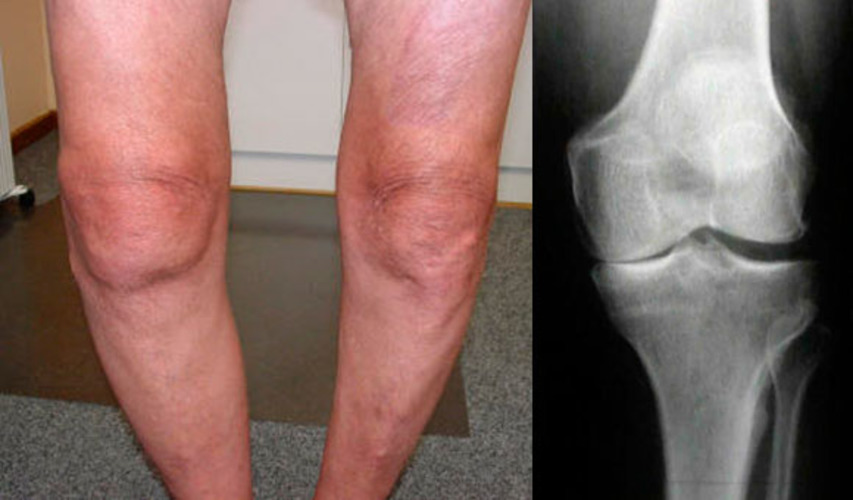Артрит коленного сустава симптомы и лечение