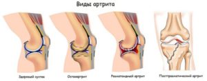 Разновидности артрита коленного сустава