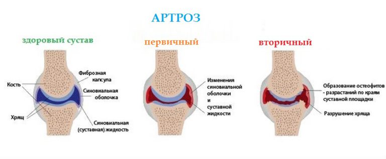 Лечение гонартроза коленного сустава 1 степени схема