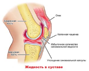 Воспаление внутри колена