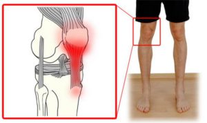 Воспаление связок коленного сустава