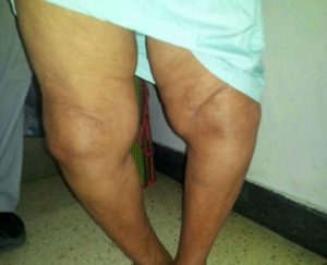 Деформация коленных суставов