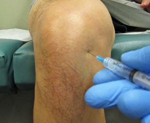 Инъекция в коленный сустав для снятия боли