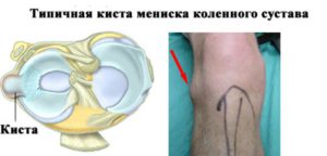 Киста мениска коленного сустава