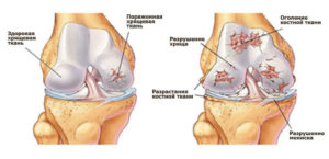 Нарушение хрящевой ткани колена