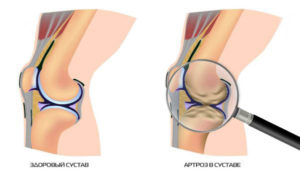 Начальная стадия артроза колена