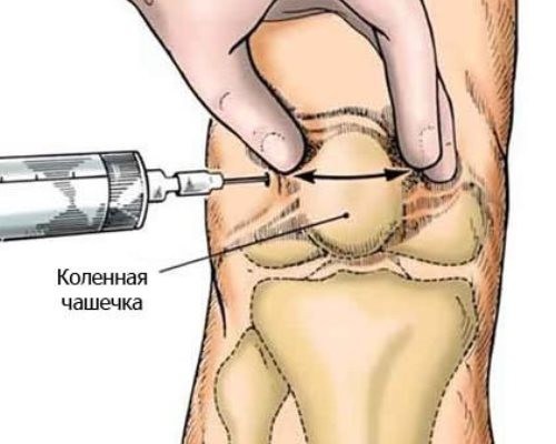 Препараты для лечения коленного сустава