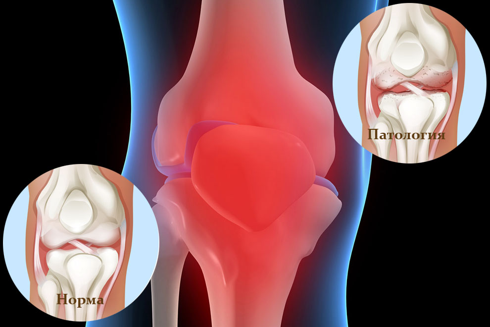 Повреждения мениска коленного сустава как лечить