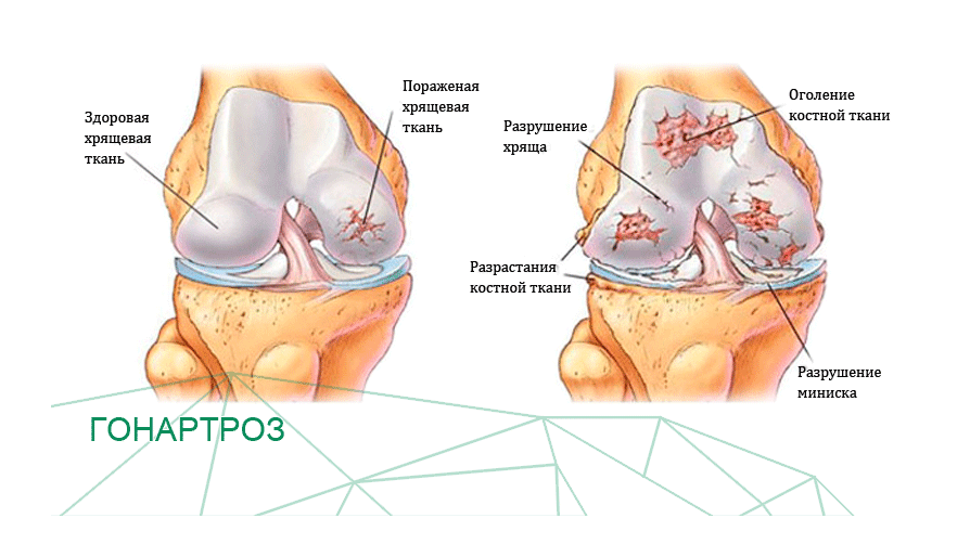 Гонартрит коленного сустава. Повреждение суставного хряща коленного сустава. Остеоартроз коленного сустава мениск. Деформирующий остеоартроз осложнения. Разрыв суставного хряща коленного сустава.