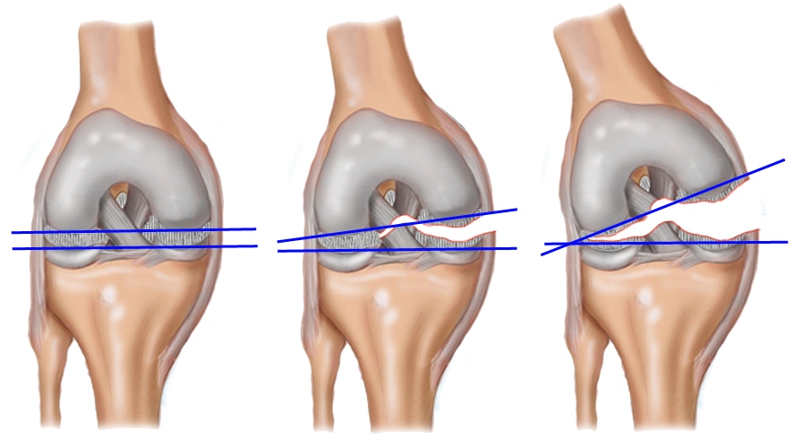 Передняя крестообразная связка коленного сустава фото