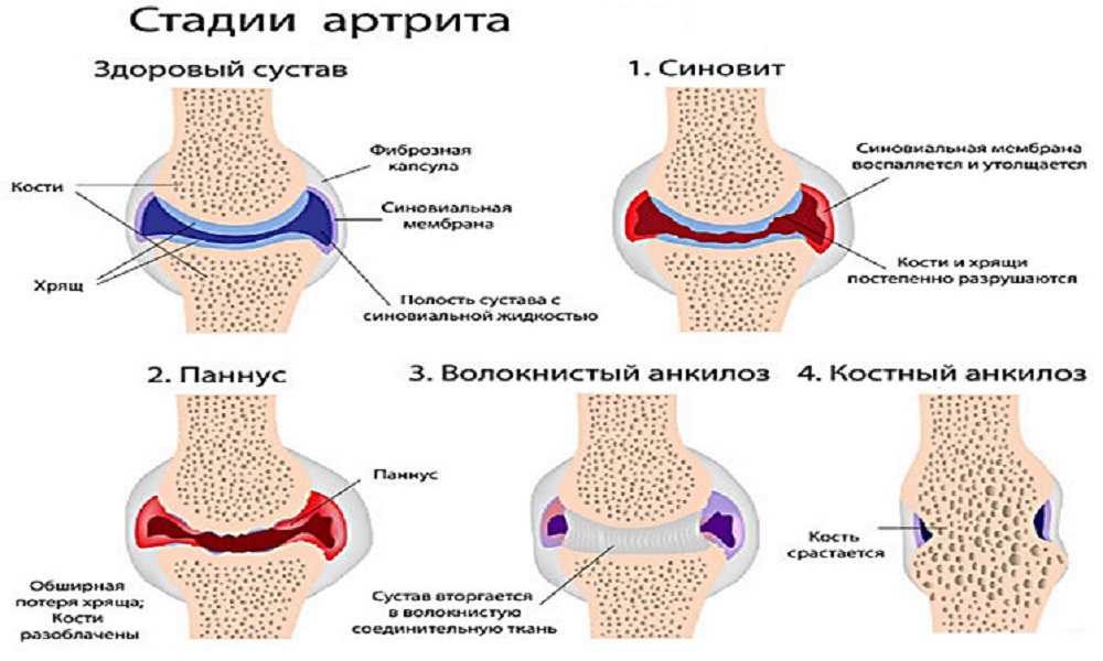 Болезнь сустав обратиться. Степени артрита коленного сустава ревматоидный. Схема суставов ревматоидный артрит. Схема поражения суставов при ревматоидном артрите. Ревматоидный артрит сустава рисунок.